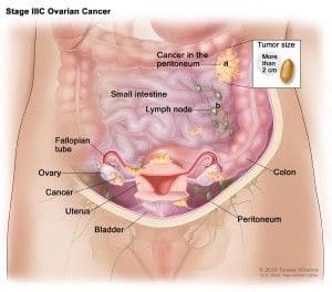 ovariancancer